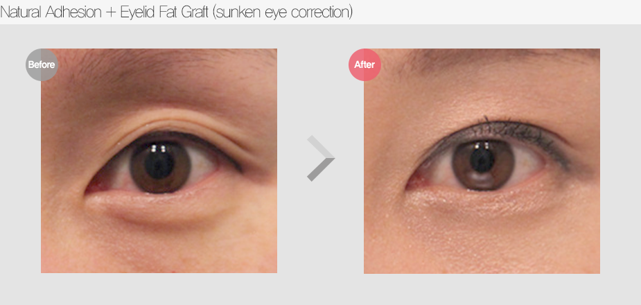 Before & After
