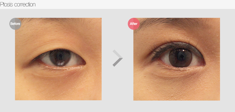 Before & After Pictures