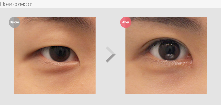 Before & After Pictures