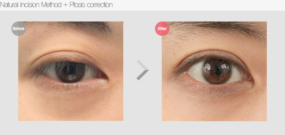 Before & After Pictures