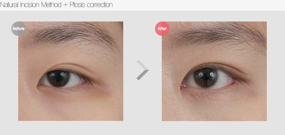 Before & After Pictures