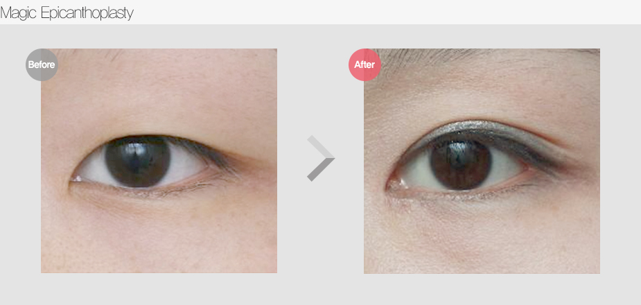 Before $ After