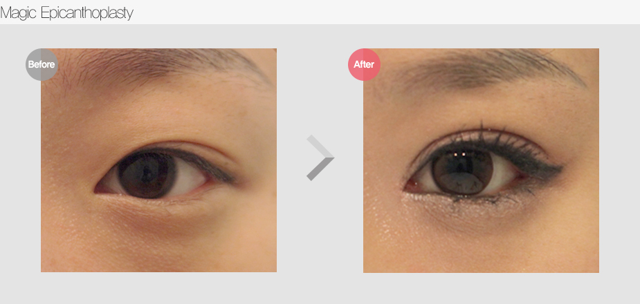 Before $ After