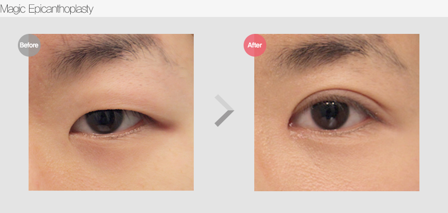 Before $ After