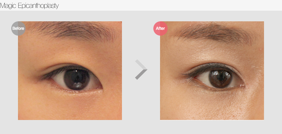 Before $ After