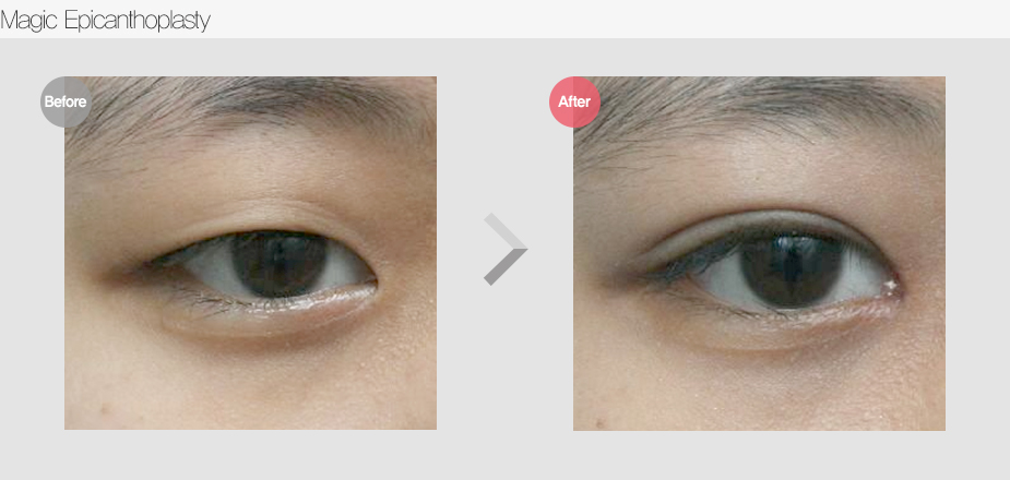 Before $ After