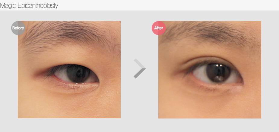 Before $ After