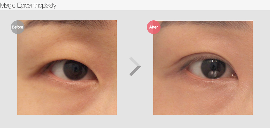 Before $ After