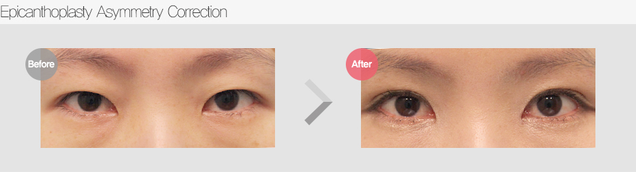 Before $ After