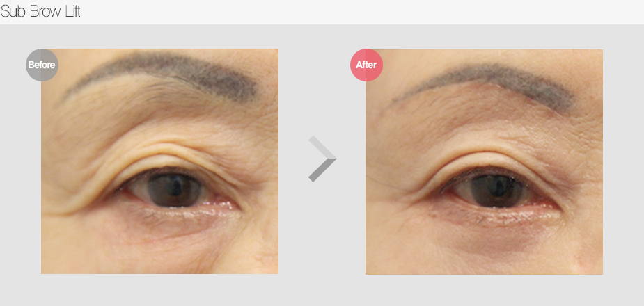 Before & After