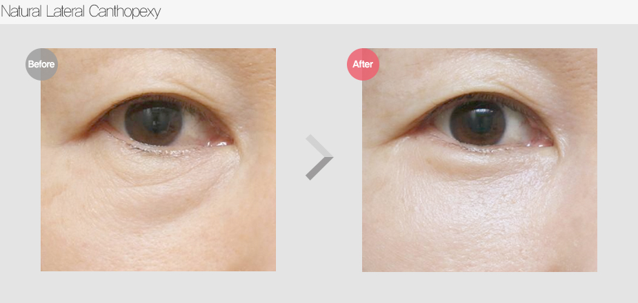 Before & After