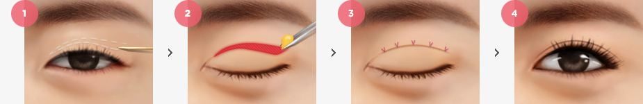 Natural Incision Method Surgery Method