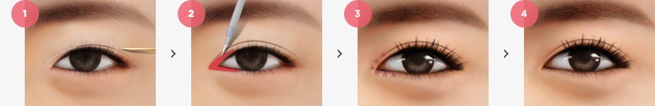 Magic Epicanthoplasty Surgery Method