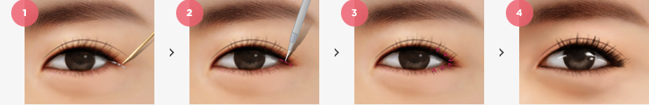 Magic Lateral Canthoplasty urgery Method