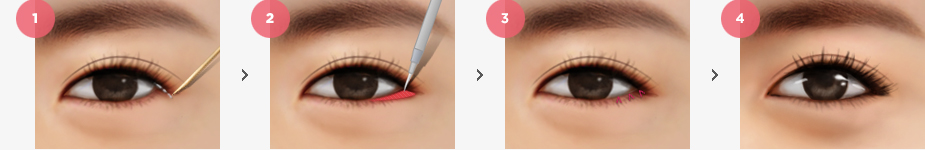 Magic Lower Epicathoplasty Surgery Method