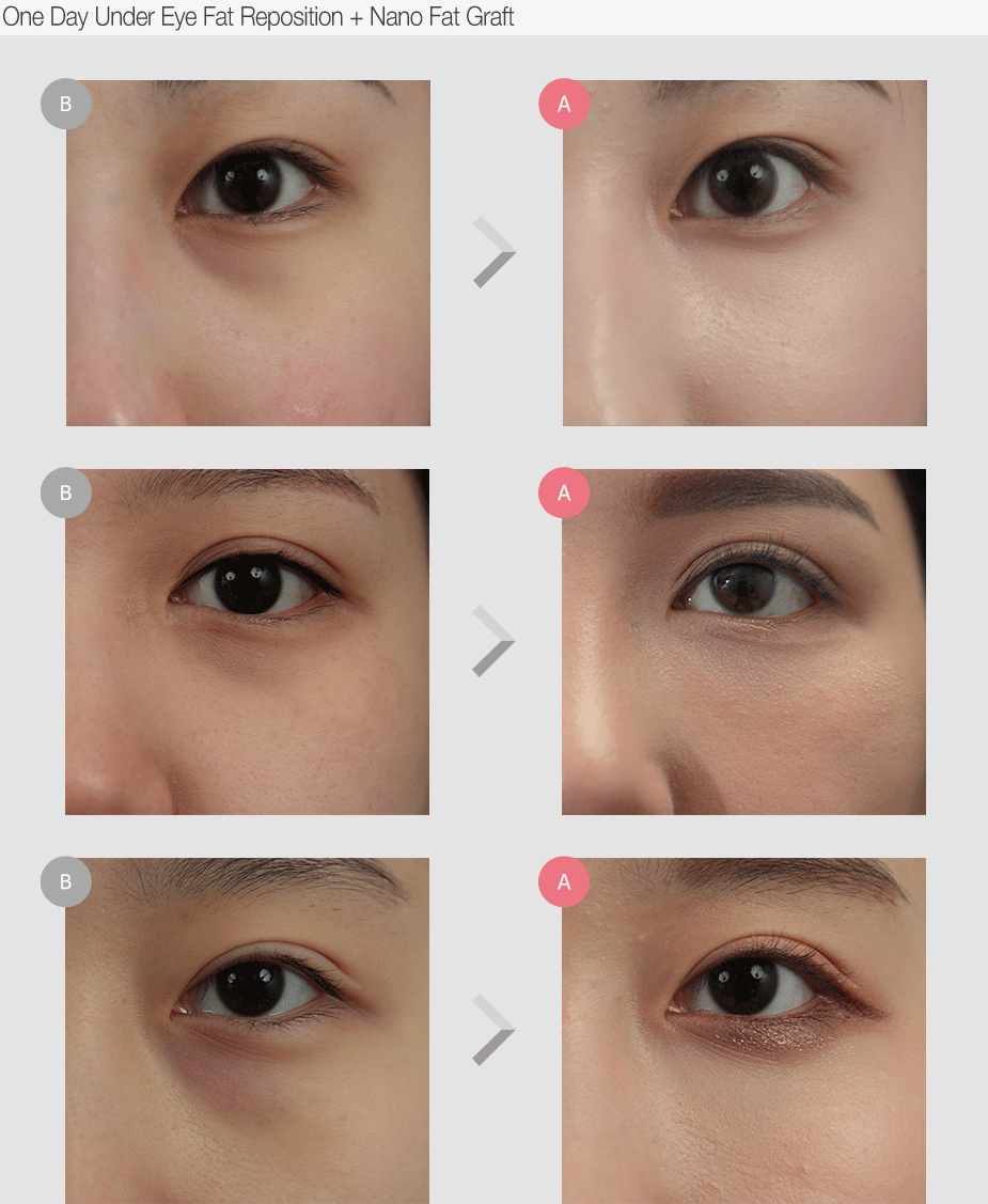 Before & After