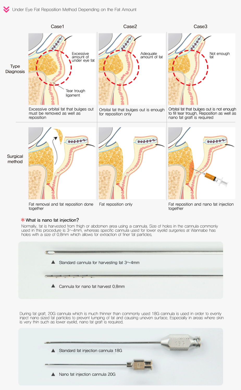 Under Eye Fat Reposition Method Depending on the Fat Amount