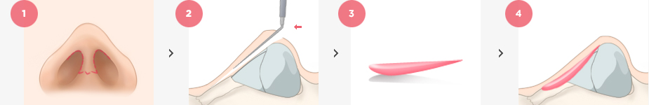 Low Nose Bridge