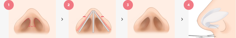 Hump nose Surgery Method