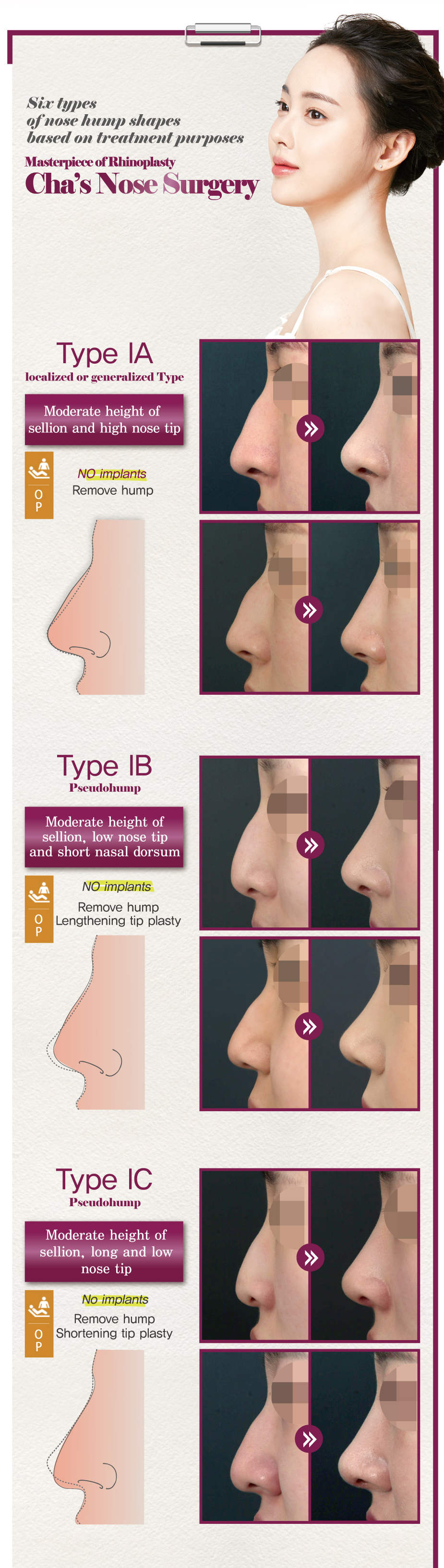 유형IA,IB,IC