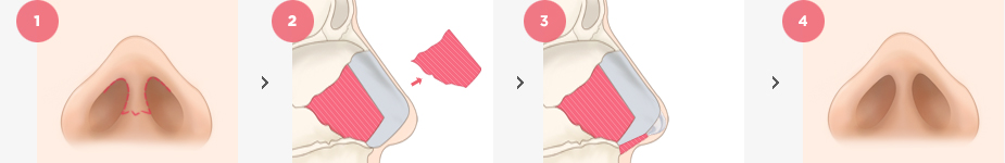 Short nose(upturned nose) Surgery Method