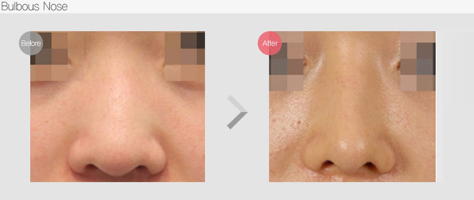 Before & After Pictures
