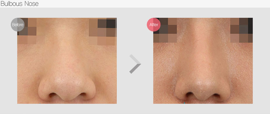 Before & After Pictures