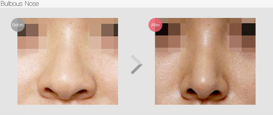Before & After Pictures