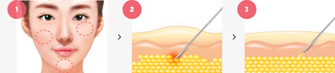 AccuLifting Surgery Method