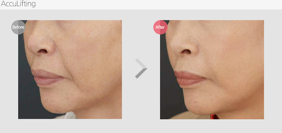 Before & After