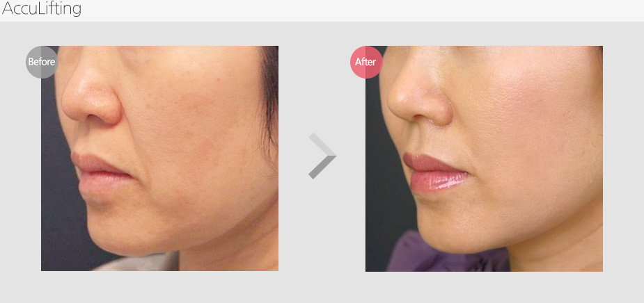 Before & After