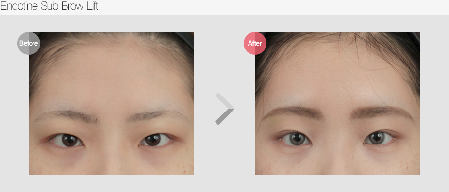 Before $ After