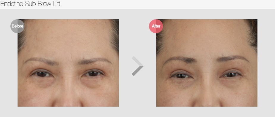 Before $ After