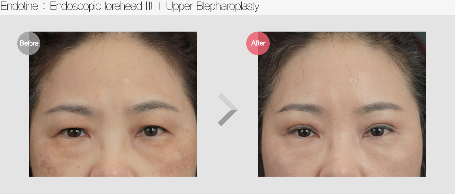 Before $ After