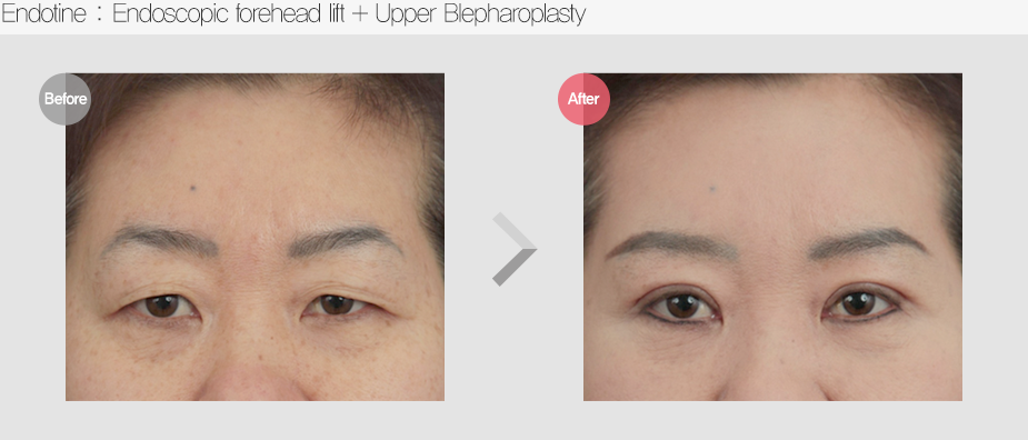 Before $ After