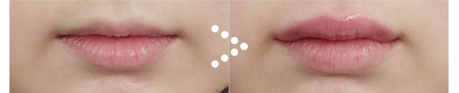 Before $ After