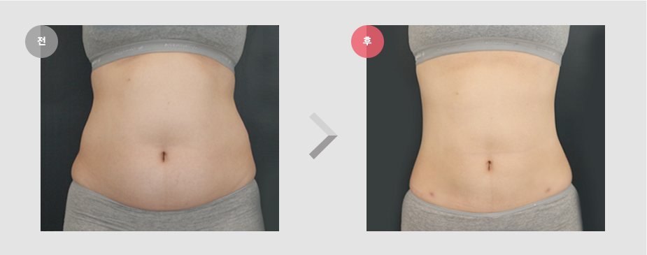 Before & After Pictures