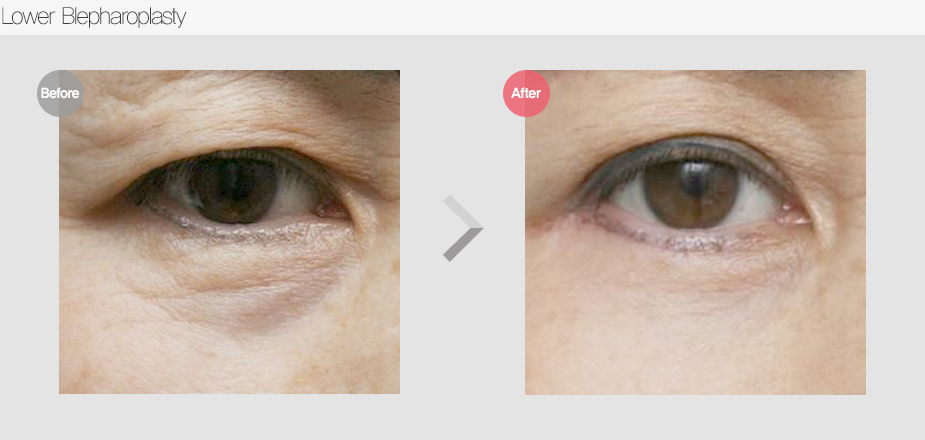 Before $ After