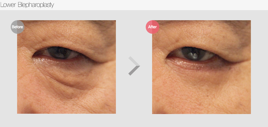 Before $ After
