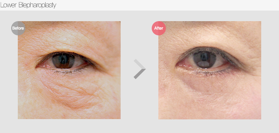 Before $ After
