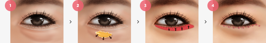 Natural Adhesion Method Surgery Method